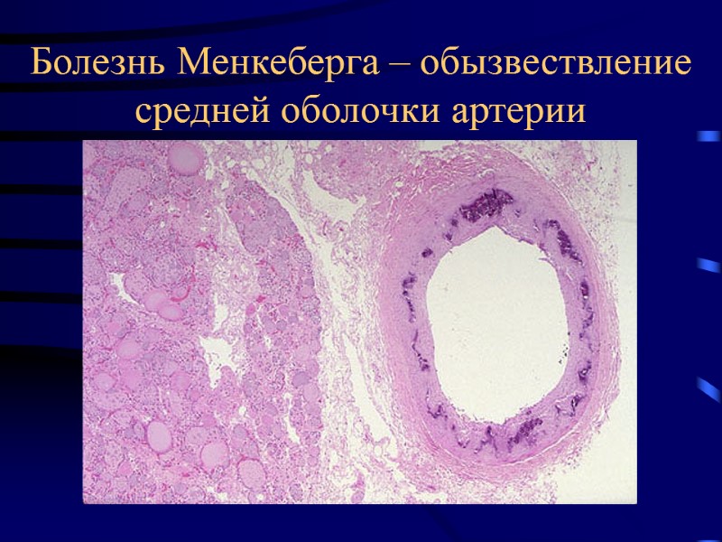 Болезнь Менкеберга – обызвествление средней оболочки артерии